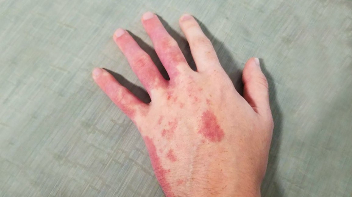 Is Exposure to Blood Stain Dangerous?